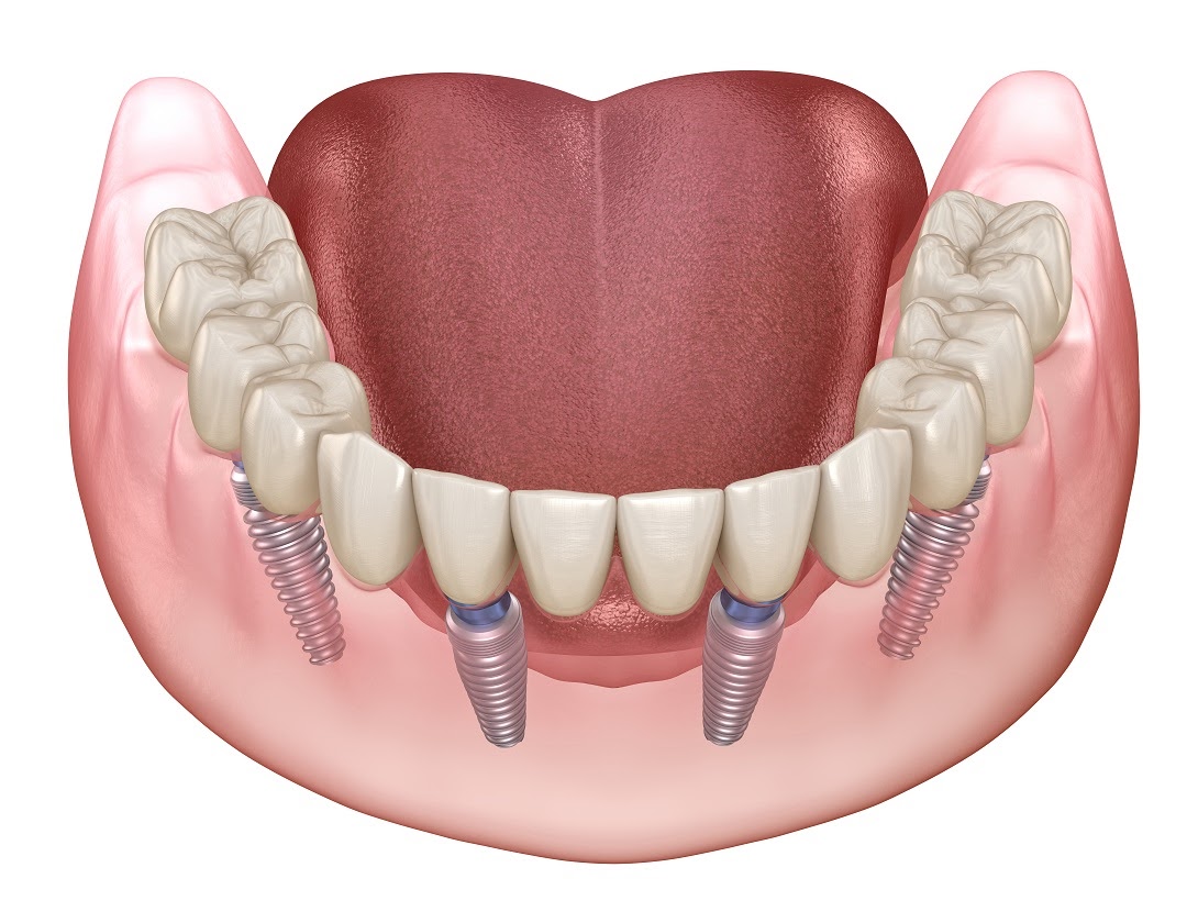 Dental Implants & Full Mouth Rehabilitation